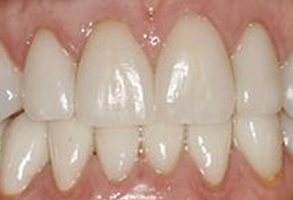 Marlon A. Goad DDS, PC | Night Guards, Crowns  amp  Caps and Dentures